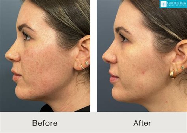 Ravengriim Before BBL: Plastic Surgery Transformation